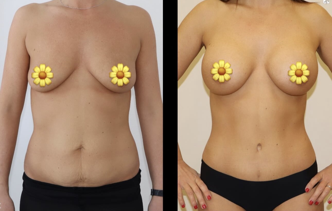 Avant/Après mommy makeover